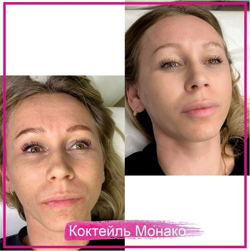 Мезотерапия - Официальный сайт клиники профессора Савицкой